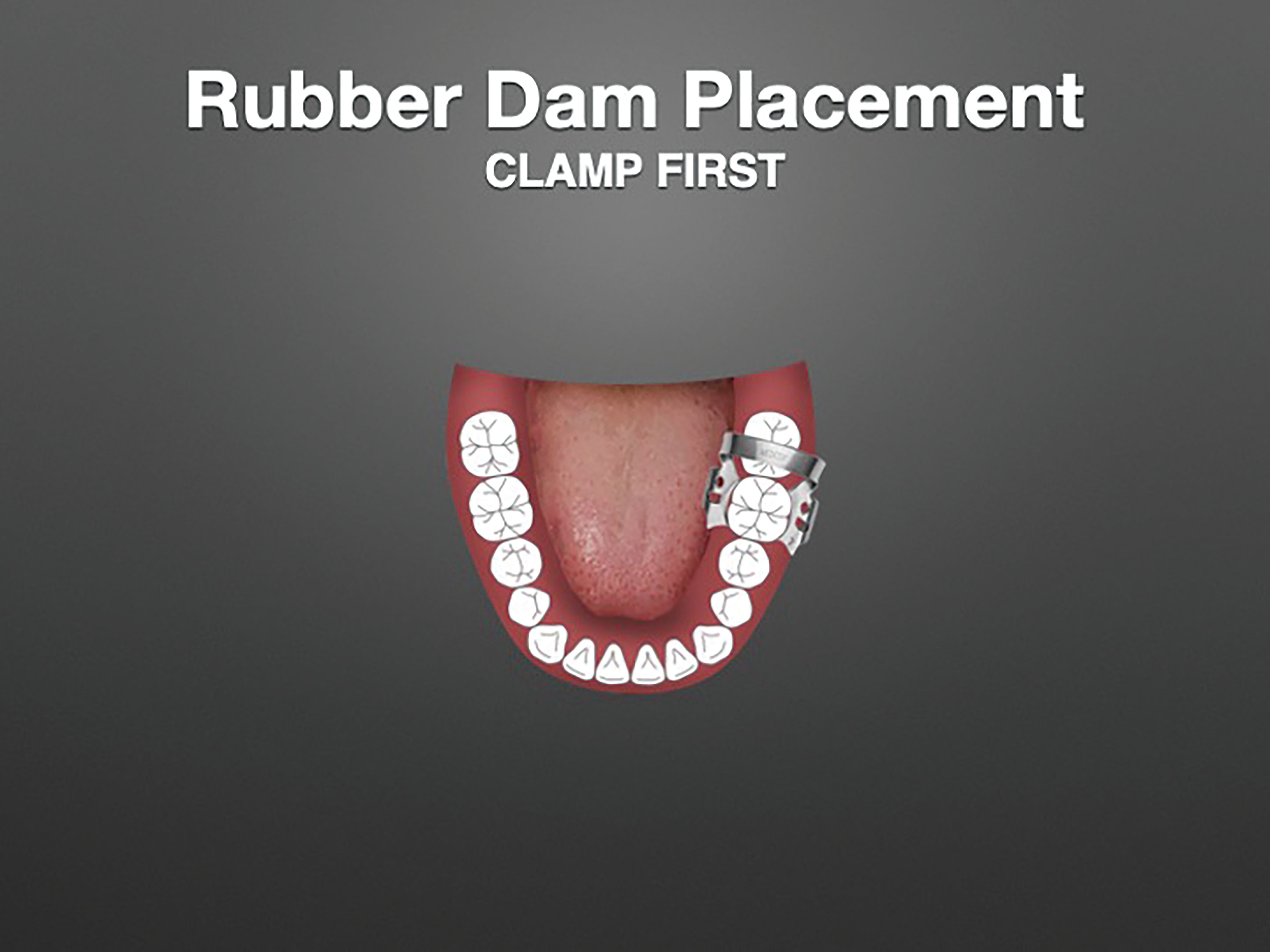 How to significantly reduce airborne particles with a rubber dam